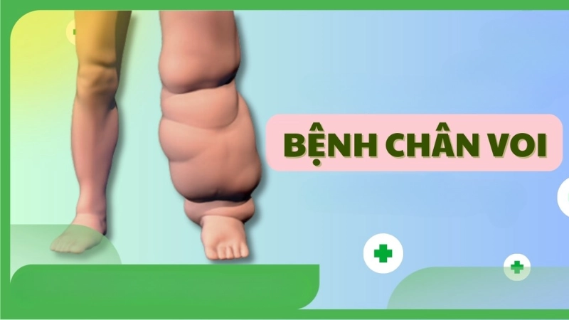 Phù chân voi là như thế nào ai cũng cần biết