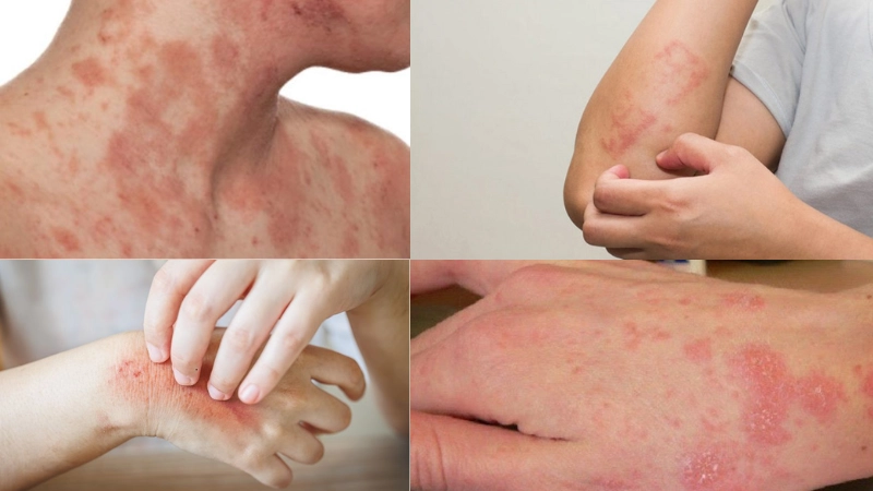 Hình ảnh bệnh nấm da là như thế nào