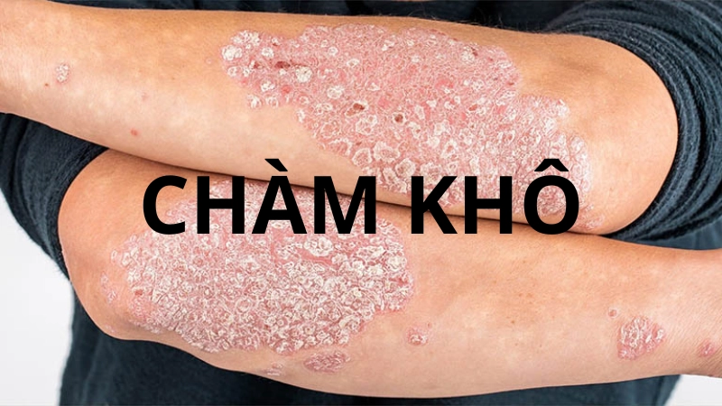 Hình ảnh bệnh chàm khô là như thế nào