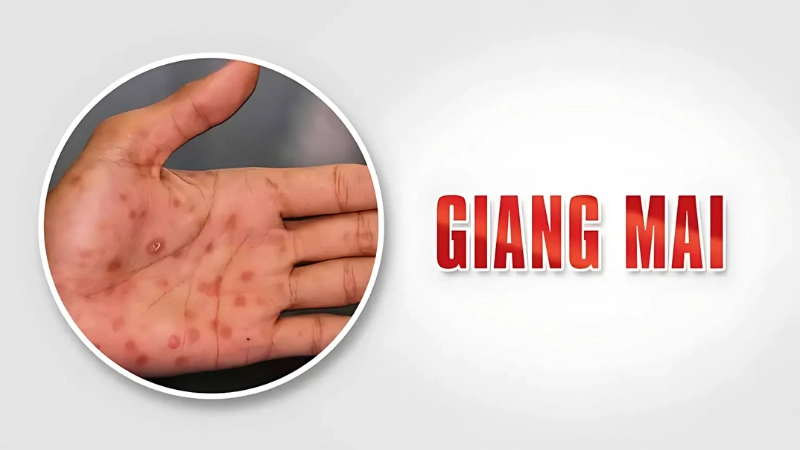 Hình ảnh bệnh giang mai là như thế nào