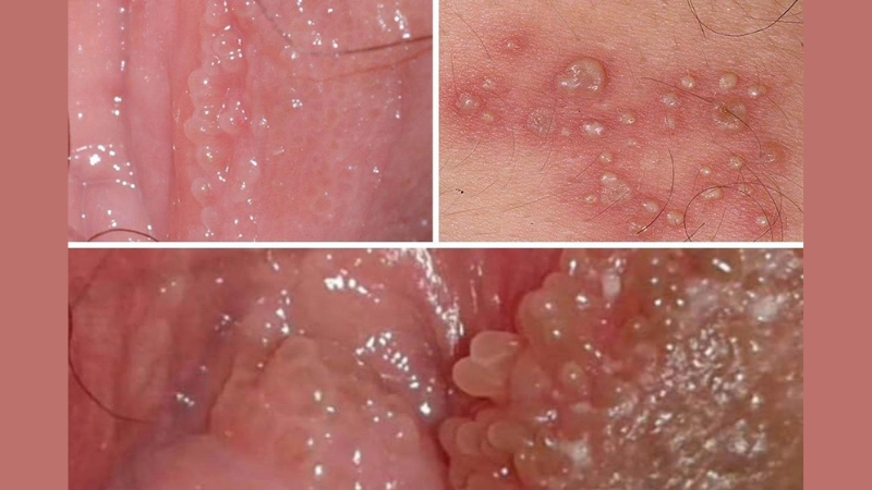 Hình ảnh bệnh sùi mào gà là như thế nào