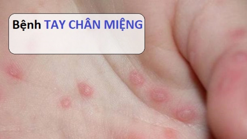 Hình ảnh bệnh tay chân miệng là như thế nào