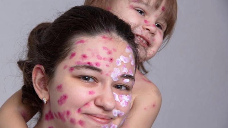 Hình ảnh bệnh thủy đậu là như thế nào