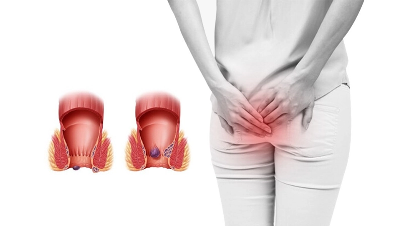 Hình ảnh bệnh trĩ là như thế nào