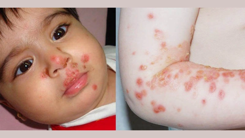 Hình ảnh bệnh viêm da mủ là như thế nào