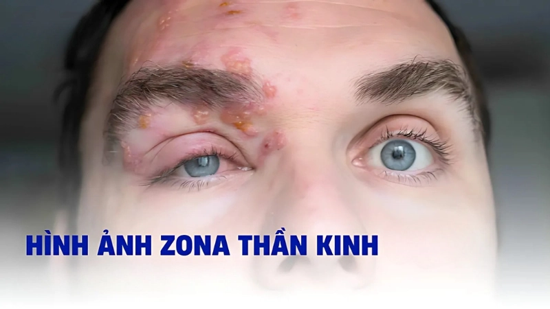 Hình ảnh bệnh zona thần kinh ở mắt là như thế nào