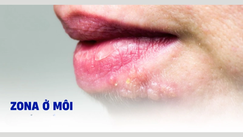 Hình ảnh bệnh zona ở môi là như thế nào