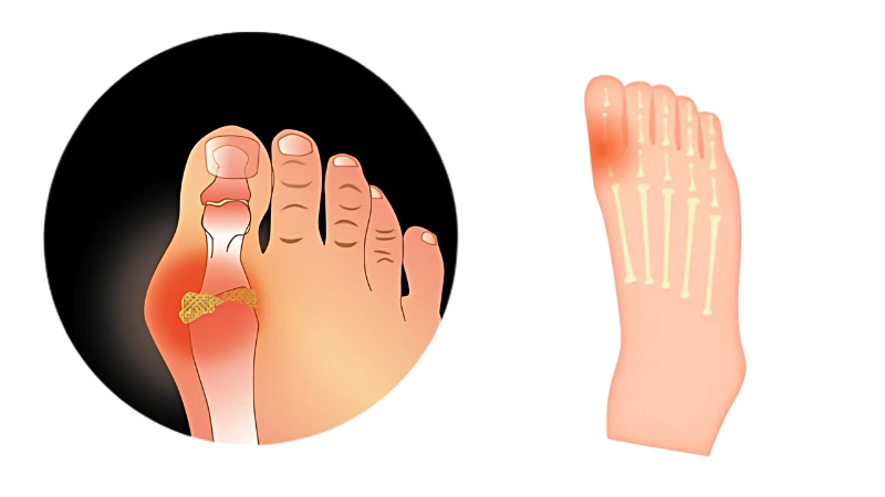 Hình ảnh bệnh gout là như thế nào