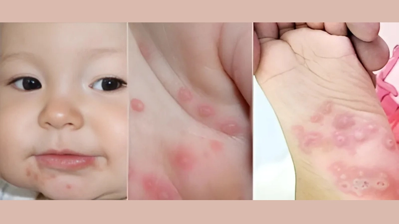 Hình ảnh bệnh tay chân miệng cấp độ 1 là như thế nào