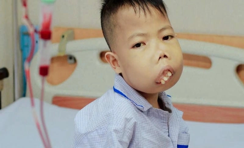 Dấu hiệu nhận biết bệnh tan máu qua hình ảnh thực tế dễ phân biệt