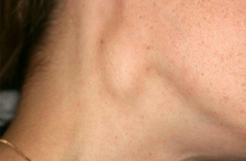 Thông tin hữu ích về bệnh hạch lao hiện nay