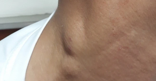 Hình ảnh chi tiết về hạch viêm lao thực tế