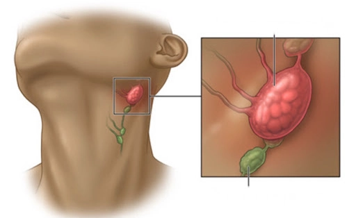 Thông tin cần biết về bệnh lao hạch ở người lớn