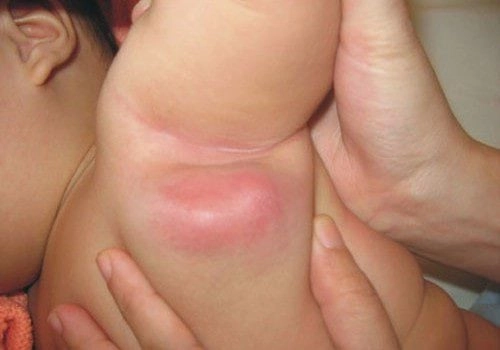 Tìm hiểu chi tiết về hạch lao ở cổ trẻ em