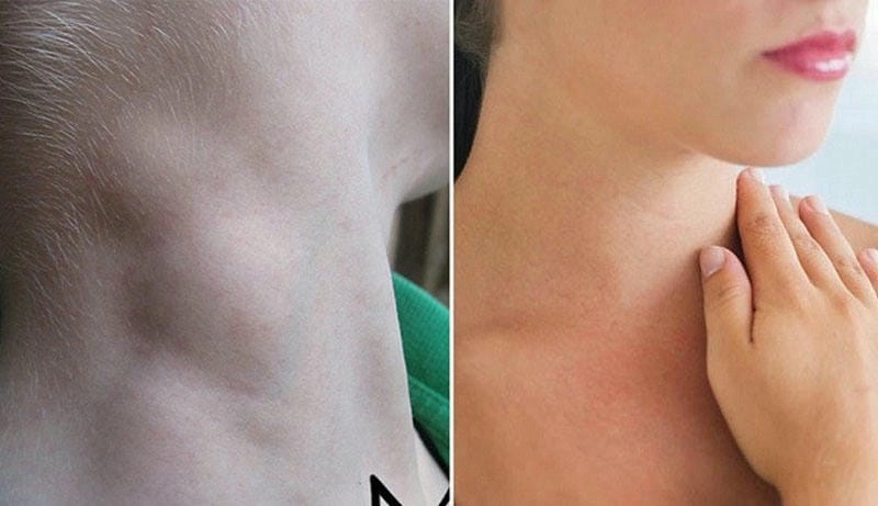 Lưu ý các dấu hiệu hạch lao dễ nhầm lẫn