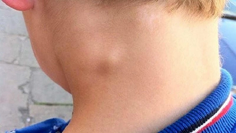 Tình trạng rõ ràng qua ảnh người bị bệnh lao hạch