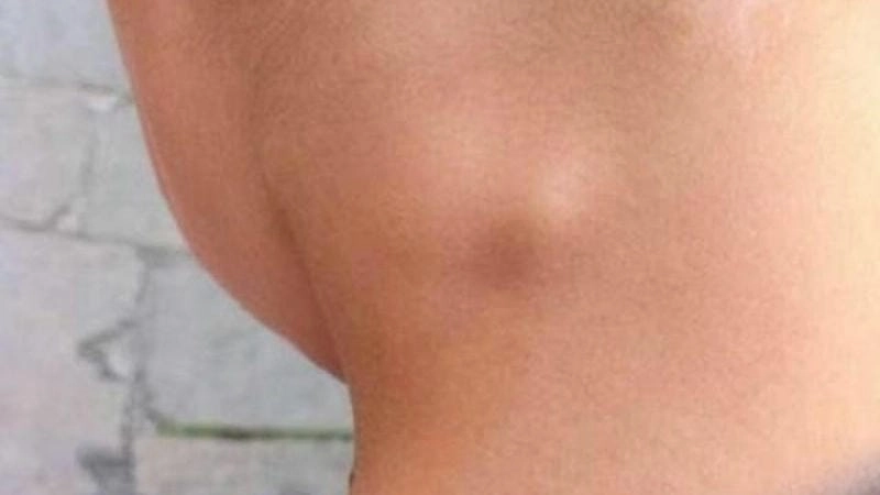 Giải thích chi tiết nguyên nhân bệnh lao hạch