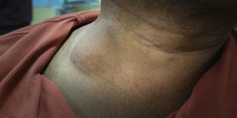 Xem chi tiết ảnh người bị lao hạch thực tế