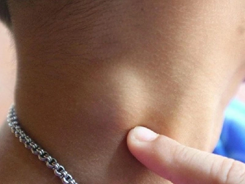 Nhận biết sớm tình trạng lao hạch trẻ em