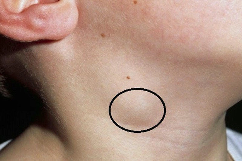 Tổng hợp các hình ảnh bệnh lao hạch thực tế