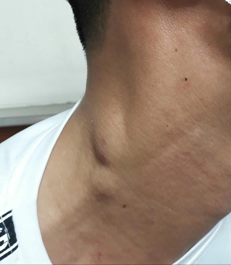 Cảnh báo từ những ảnh bệnh lao hạch chân thực