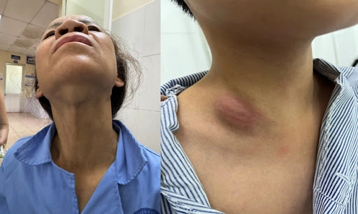 Khám phá triệu chứng lao hạch sưng đỏ ở cổ