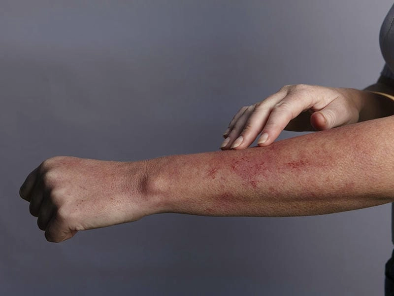 Khám phá hình ảnh bệnh aids chân thực