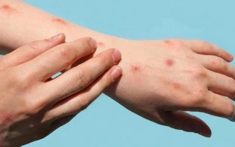Toàn cảnh hiv aids hình ảnh chi tiết