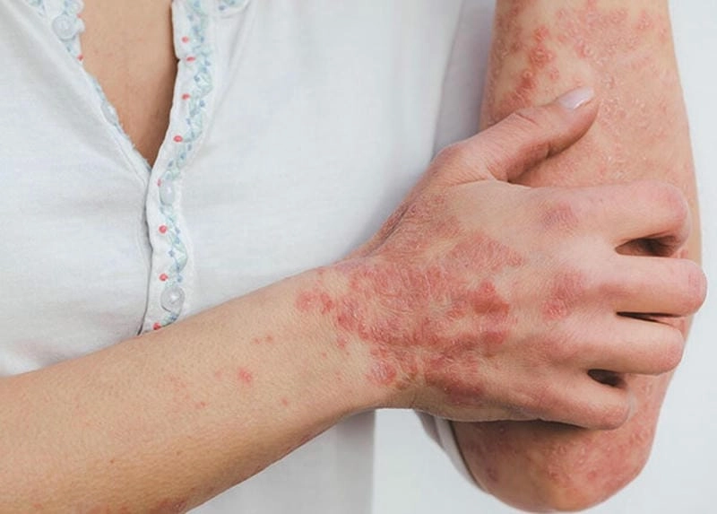 Chia sẻ hình ảnh hiv aids chân thực nhất