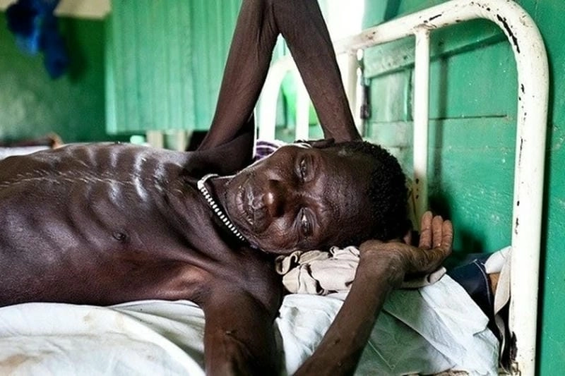 Tìm hiểu hình ảnh về bệnh hiv aids rõ nét