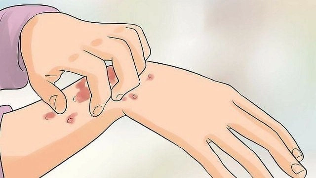 Hiểu rõ hình ảnh biến chứng hiv nghiêm trọng