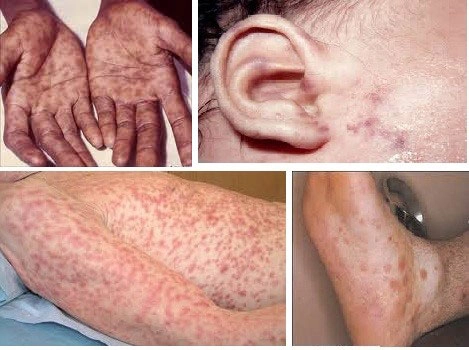 Xem kỹ hình ảnh người mắc bệnh aids tại Việt Nam
