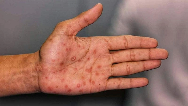 Thực tế đau lòng qua hình ảnh bệnh hiv/aids