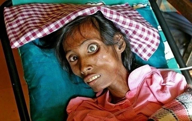 Xem rõ hinh anh nguoi bi nhiem hiv giai đoạn cuối