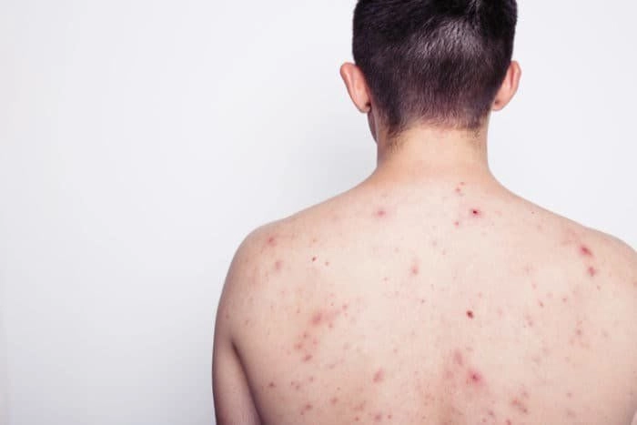 So sánh hình ảnh trước và sau khi nhiễm hiv