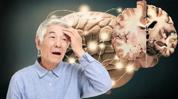 Phương pháp hỗ trợ điều trị bệnh alzheimer minh họa qua ảnh