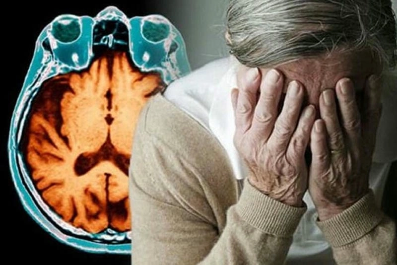 Nhìn rõ biểu hiện qua ảnh người bị bệnh alzheimer