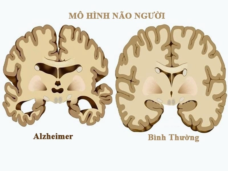 Khám phá bệnh alzheimer hay sa sút trí tuệ qua ảnh thực tế