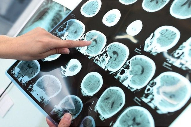 Khám phá hình ảnh bệnh alzheimer giai đoạn cuối rõ rệt nhất