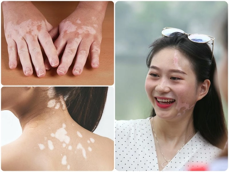 Xem rõ triệu chứng bệnh bạch hầu ở người lớn