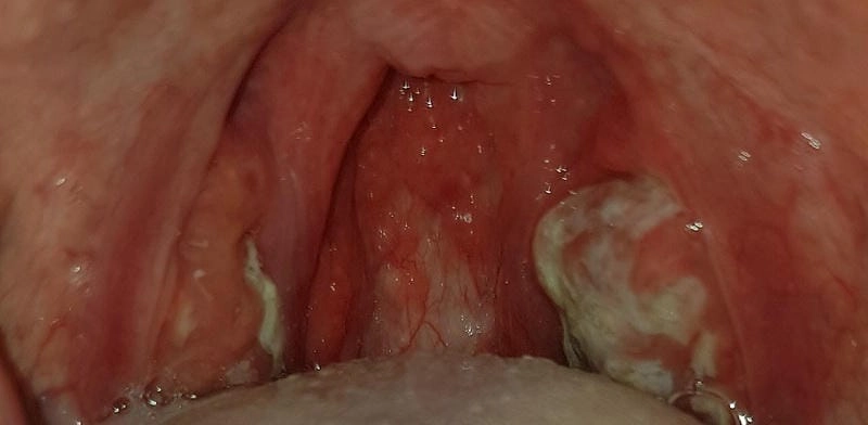 Nhận diện sớm qua hình ảnh bạch hầu