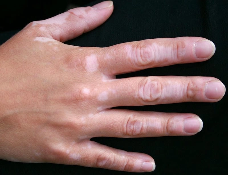 Tìm hiểu dấu hiệu hạch bạch hầu ở cổ