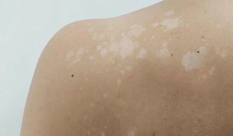 Phân tích rõ ràng từ hình ảnh bị bệnh bạch hầu