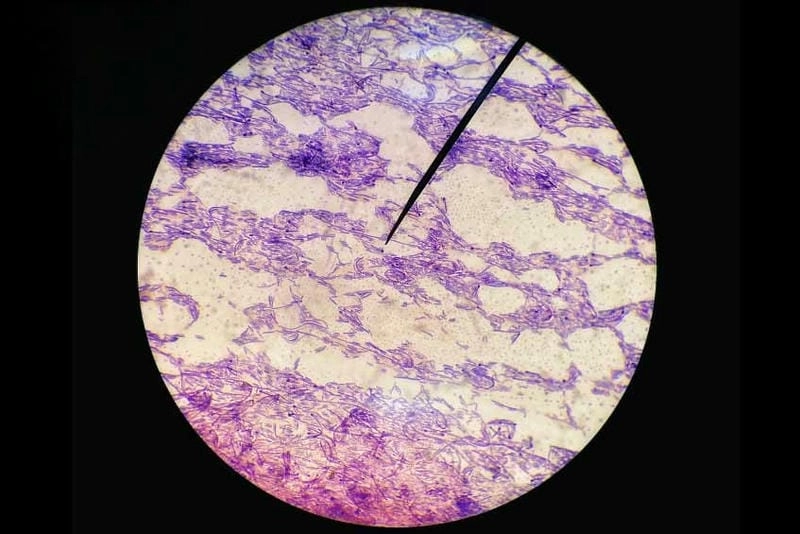 Nhận diện sớm qua hình ảnh bị bạch hầu