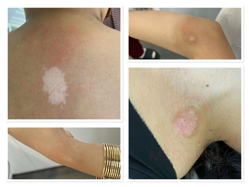 Cảnh báo sớm từ hình ảnh về bệnh bạch hầu