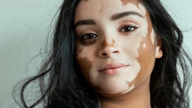 Hình ảnh thực tế của bạch biến ở mặt rõ nét