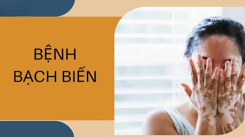 Hình ảnh bệnh bạch biến là như thế nào 