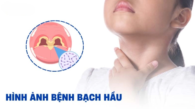 Hình ảnh bệnh bạch hầu là như thế nào