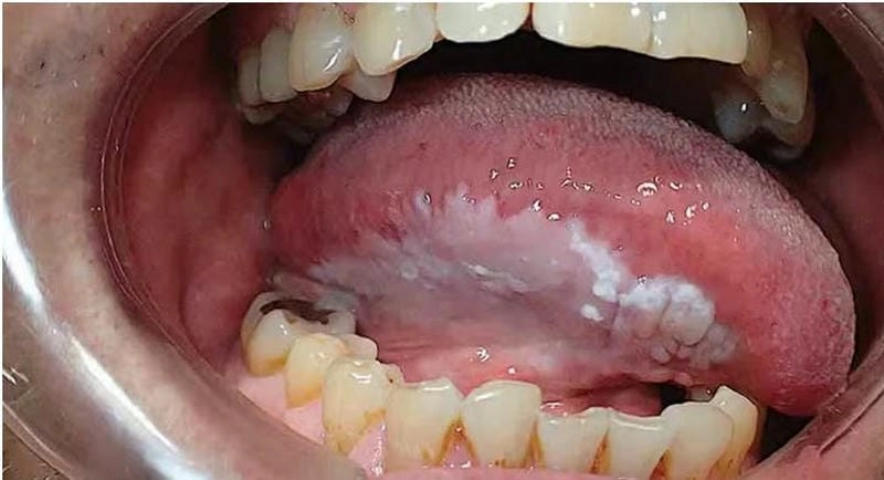 Tìm hiểu bệnh bạch sản lưỡi qua hình ảnh y khoa rõ nét