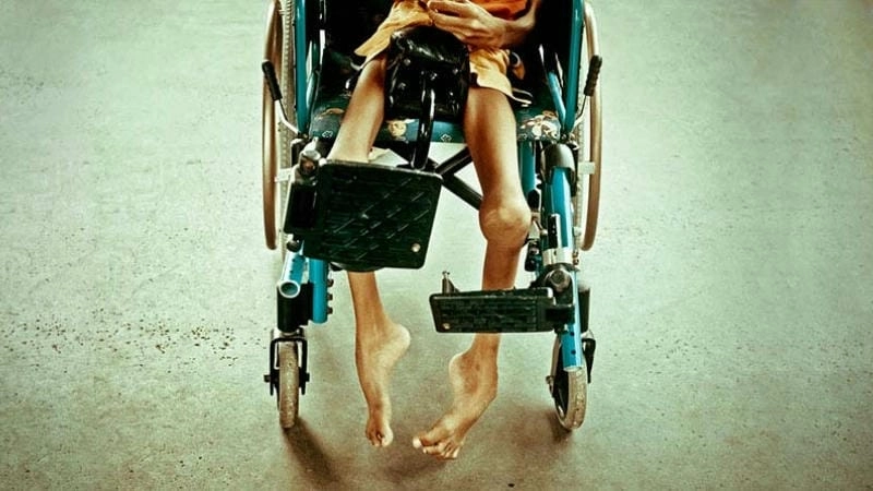 Hình ảnh mô tả rõ bệnh bại liệt chi tiết thực tế